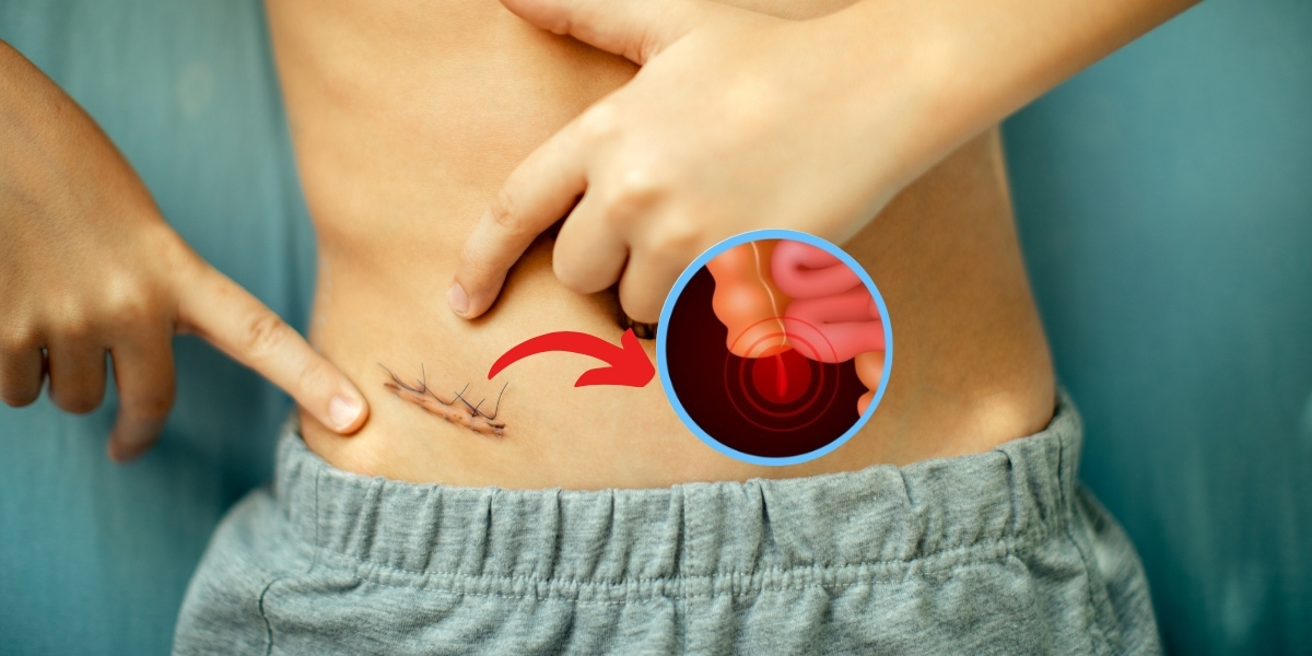 Appendix Surgery